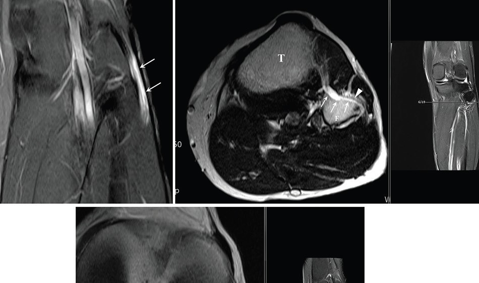 서울성모병원 손병철 교수, 희귀 난치성 양성종양 발생 기전 확인